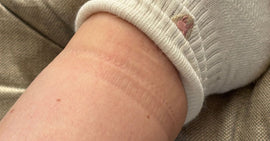 Deep sock-mark ring left below the knee by a compression sock top that rolled