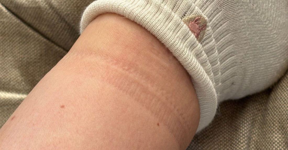 Deep sock-mark ring left below the knee by a compression sock top that rolled